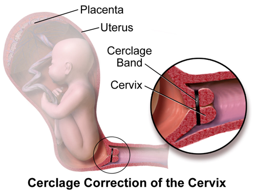Cerclage Correction of the Cervix