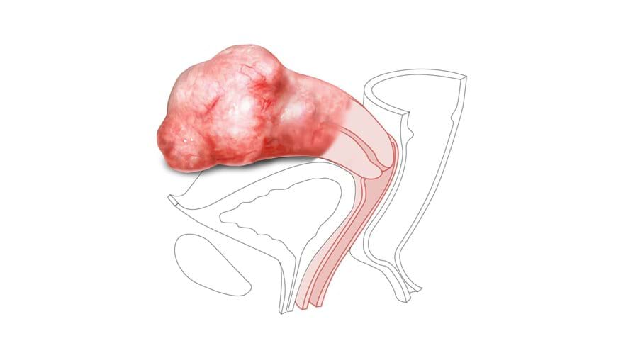 The Large Fibroid Nulliparous Ectropion Cervix for the Standard and Advanced Limbs & Things CFPT Mk3 Trainer by limbs and things 