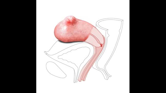 The Small Fibroid Nulliparous Polyp Cervix works with the Standard and Advanced Limbs & Things CFPT Mk3 Trainer.