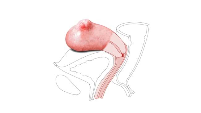 The Small Fibroid Nulliparous Polyp Cervix works with the Standard and Advanced Limbs & Things CFPT Mk3 Trainer.