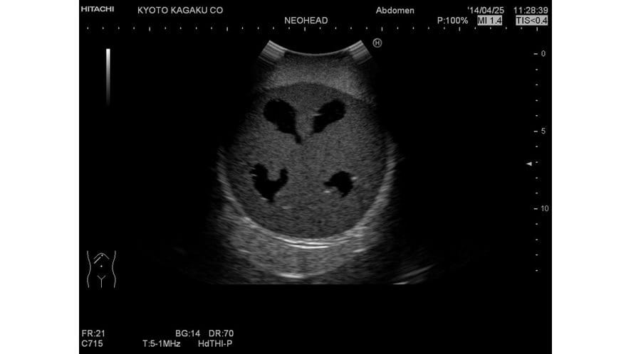 Ultrasound image using the Ultrasound Neonatal Head Phantom - Abnormal