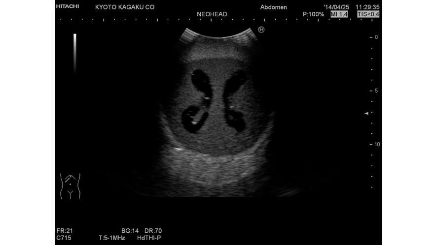 ultrasound image using the Ultrasound Neonatal Head Phantom - Abnormal