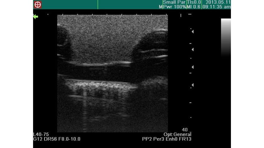 Ultrasound image using the Combined Ultrasound Guided Thoracentesis/ Pericardiocentesis