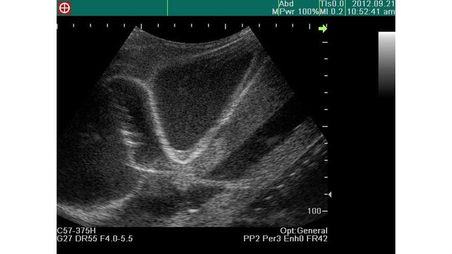 Ultrasound representation using the Combined Ultrasound Guided Thoracentesis/ Pericardiocentesis