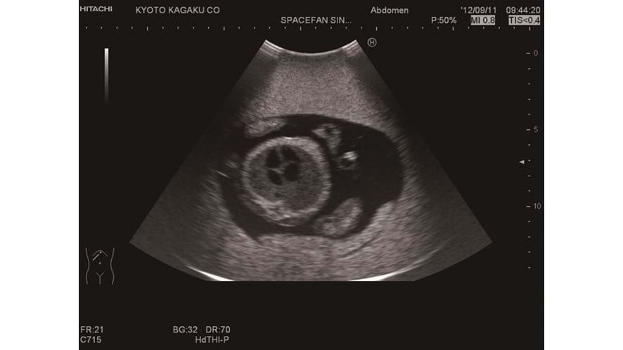 Ultrasound image using the SPACEFAN-ST Fetus Ultrasound Examination Trainer