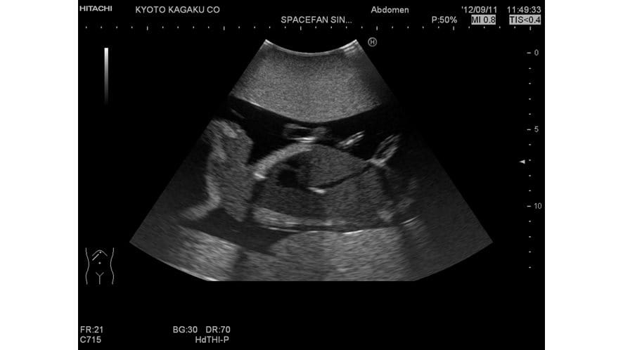Ultrasound photo using the SPACEFAN-ST Fetus Ultrasound Examination Trainer