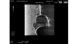 Ultrasound image using the Infant Hip Sonography Training Phantom