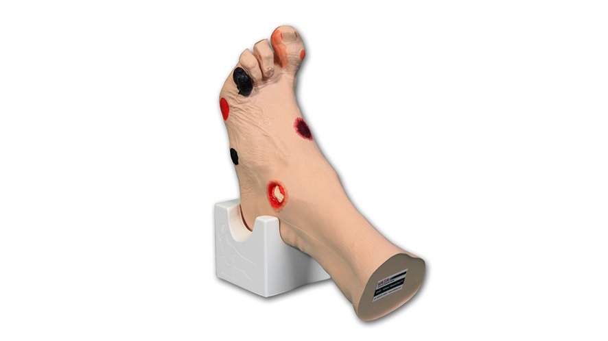 Wilma Wound foot for disease and injury management 