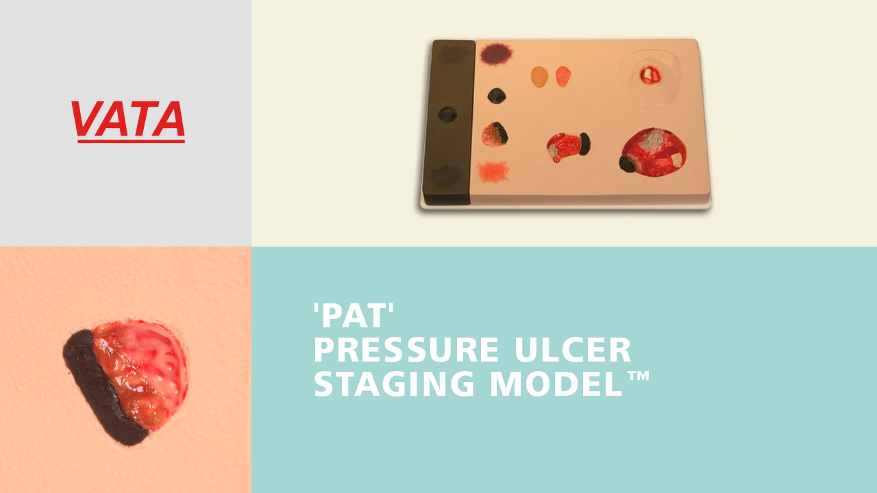 'Pat’ Pressure Ulcer Staging Model™