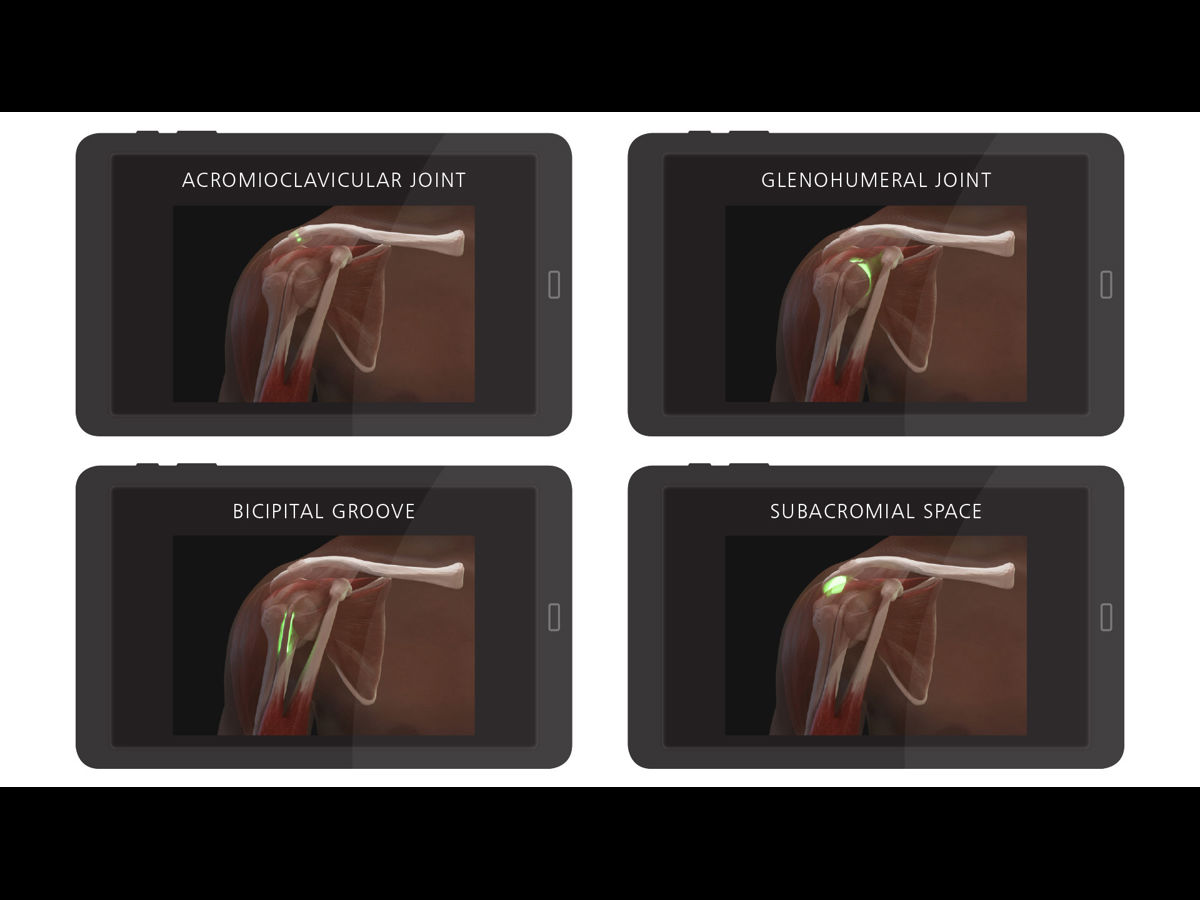 Shoulder Ir Injection Shoulder Injection Trainer - Palpation Guided (Light Skin Tone) | Limbs ...