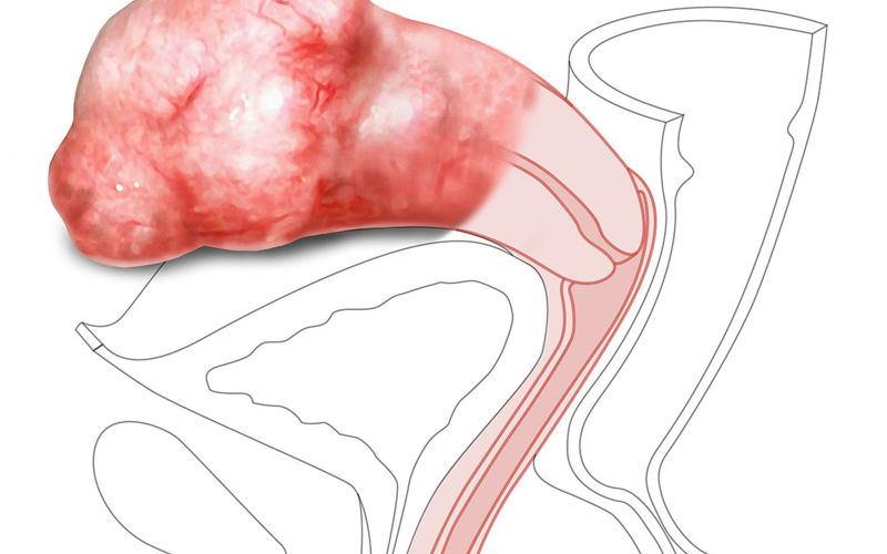 CFPT Mk 3 Module 5: Retroverted Uterus - Multiparous Cervix | Limbs ...